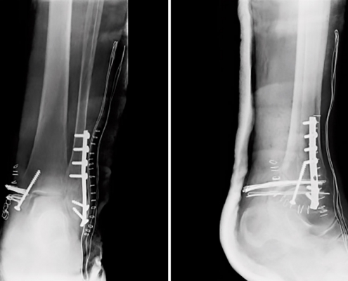 fractura tibia perone