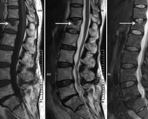 fractura vertebra