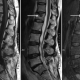 fractura vertebra