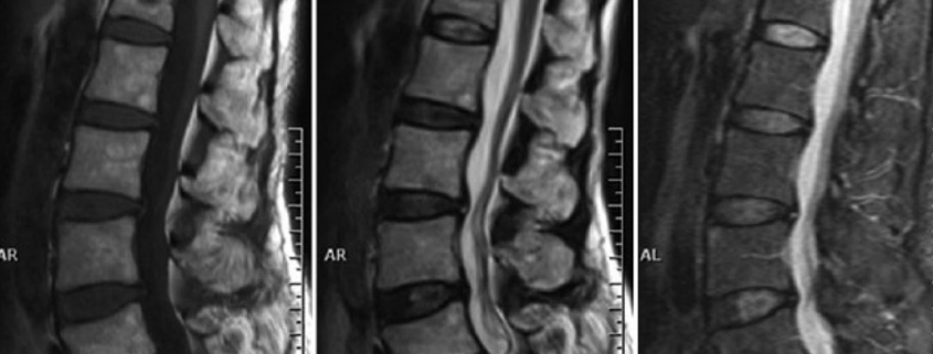 fractura vertebra