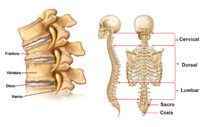 fractura de vertebra art