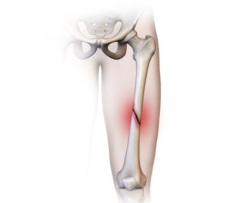 fractura femur