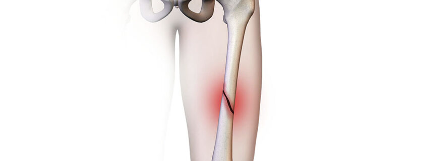 fractura femur