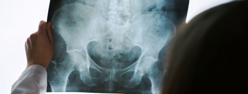 indemnizacion fractura pelvis