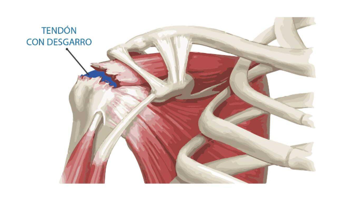 lesion del manguito rotador