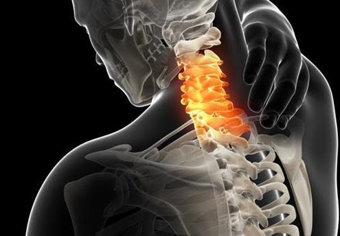 Cervicobraquialgia