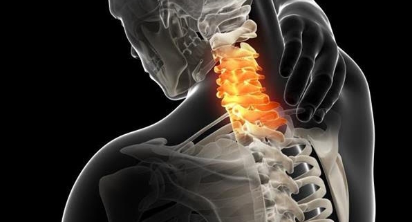 Cervicobraquialgia