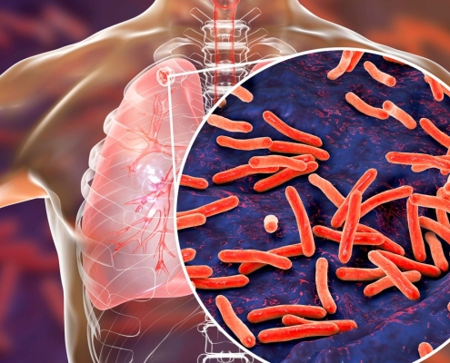 tuberculosis