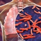 tuberculosis