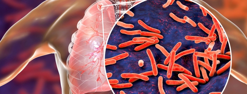 tuberculosis
